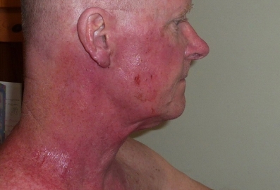 Post-radiotherapy burns