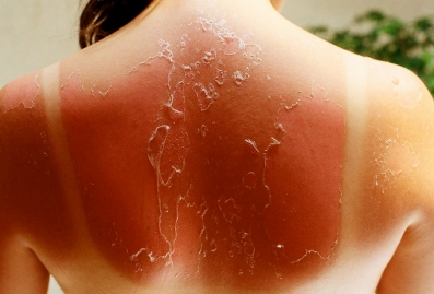 Sunburns