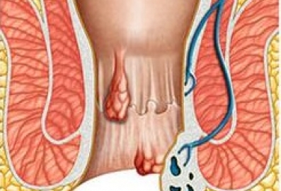 Hemorrhoids